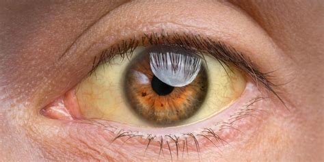 ojos amarillos anemia-4